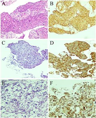 Case report: Clinical report of co-occurrence of pituitary adenoma and meningioma in the sellar region after meningioma treatment